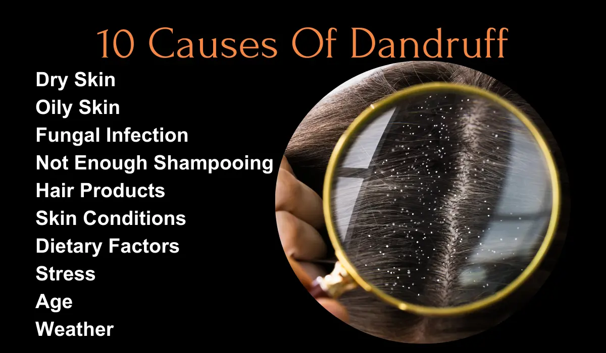 10 Causes Of Dandruff 10 Causes Of Dandruff